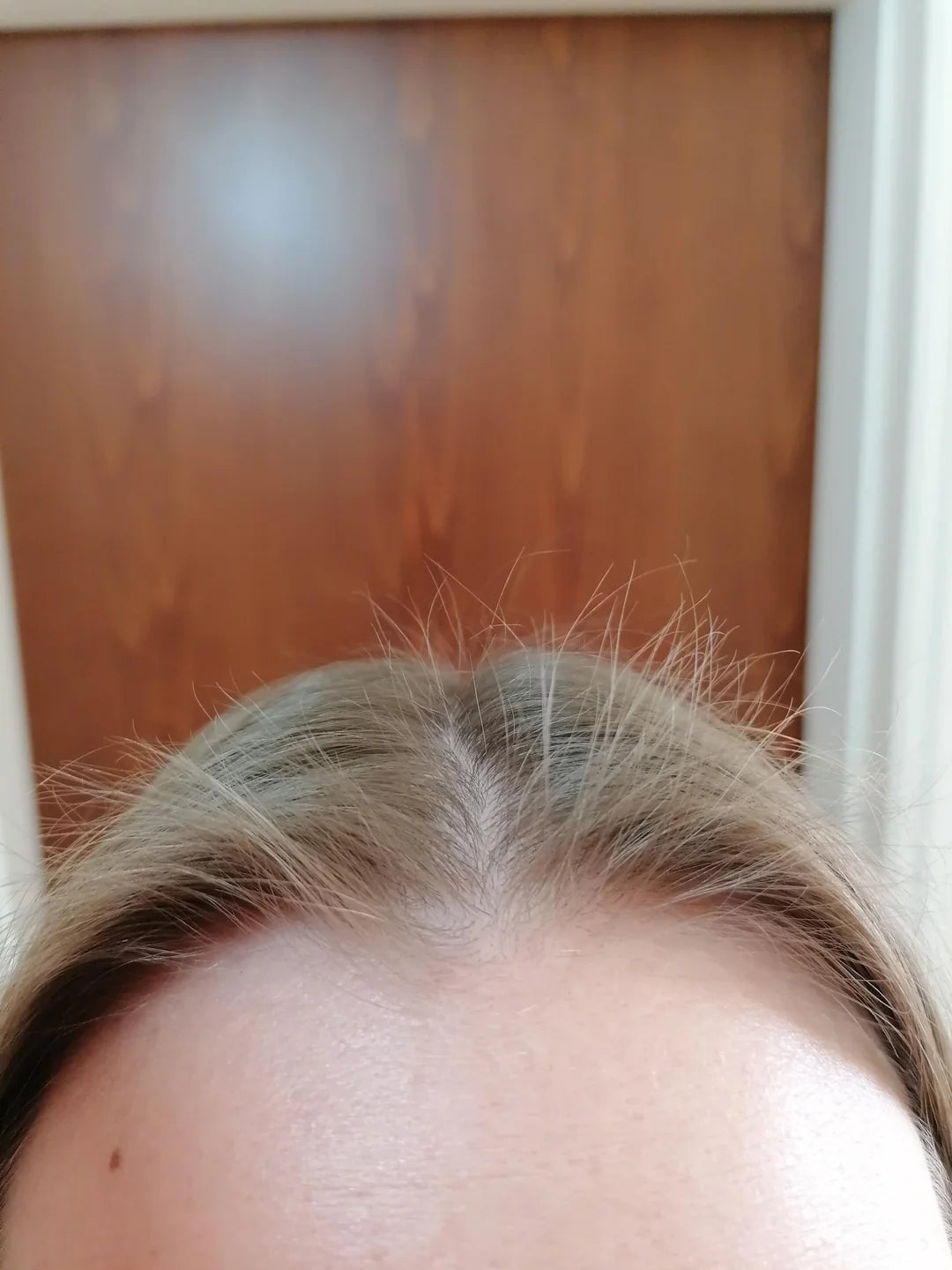 Baby hairs along the hairline indicating regrowth